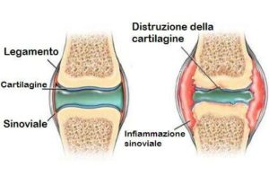 Distruzione delle cartilagini e infiammazione sinoviale