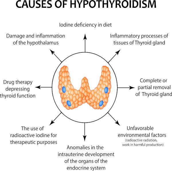 cause ipotiroidismo - info grafica